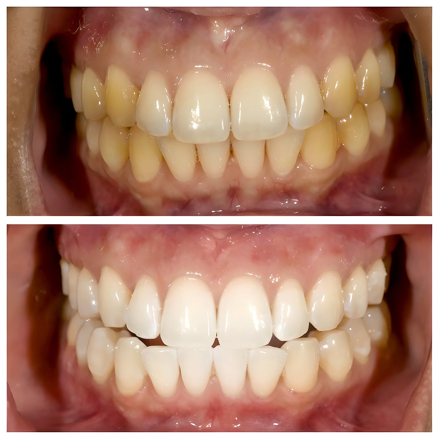 Unpore 7-Probiotic Purple Whitening Toothpaste