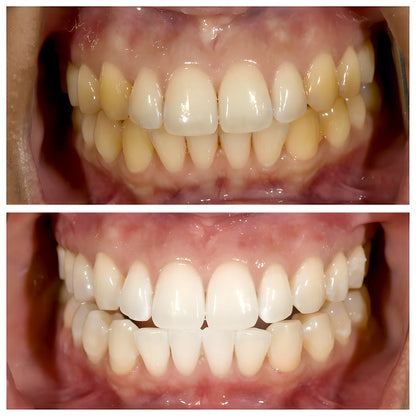 Unpore 7-Probiotic Purple Whitening Toothpaste